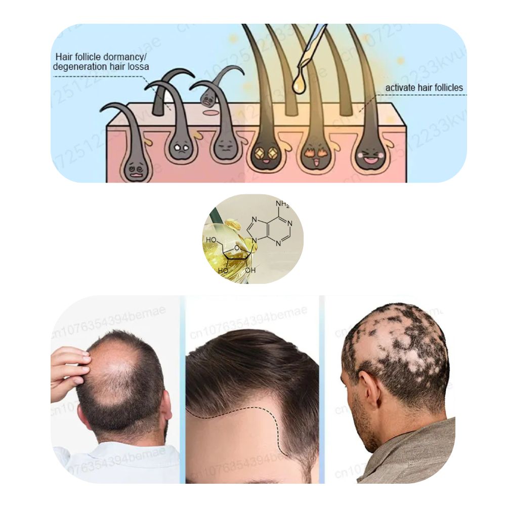 Sérum de croissance des cheveux ADENOSIN | Traitement rapide de la chute des cheveux dans les alopécies héréditaires et séborrhéiques 